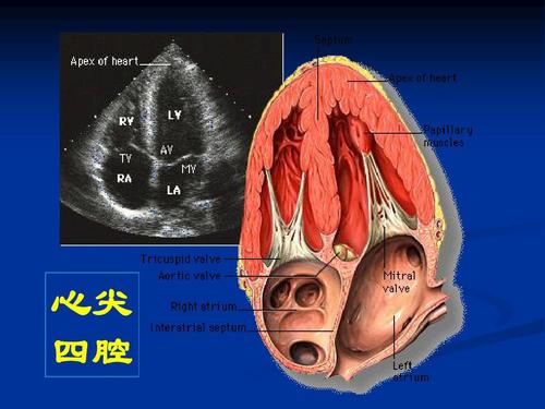 心尖 四腔