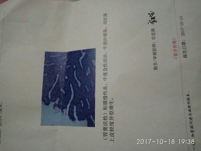 胃窦活检,粘膜慢性炎,中度急性活动,中度hp感染,局在腺上皮轻度异型