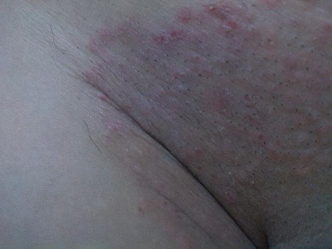 屁股也有,以为是毛囊炎