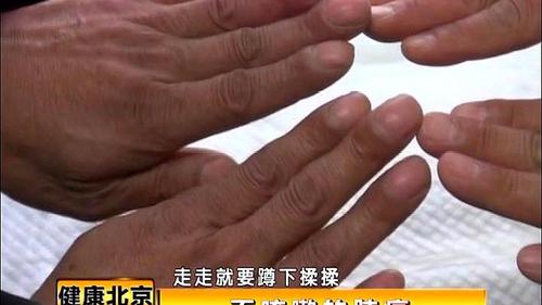 仔细问诊后,医生直言:这是肺癌导致的 服务升级 3看指甲真能看出癌症