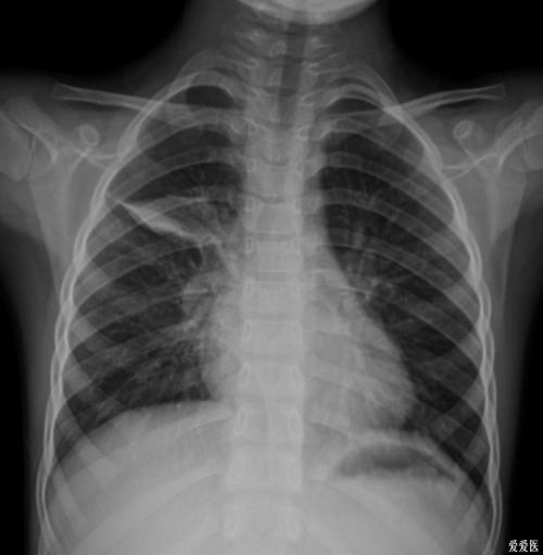 胸部正,侧位dr片——治疗前后摄片对比