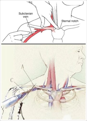 我科改良后的锁骨下静脉穿刺置管方法值得推广