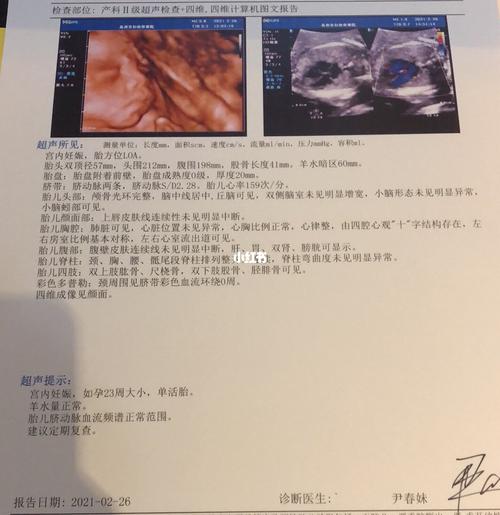 住院保胎后～24周四维通过_产检_四维彩超_四维彩超照_母婴_孕产经验