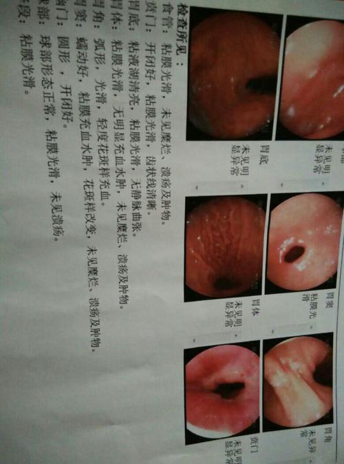 我有胃病,前两年去检查是慢性胃炎,还有点破皮,也没去
