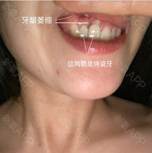 烤瓷牙与全瓷牙有什么区别?看完所有问题都会迎刃而解