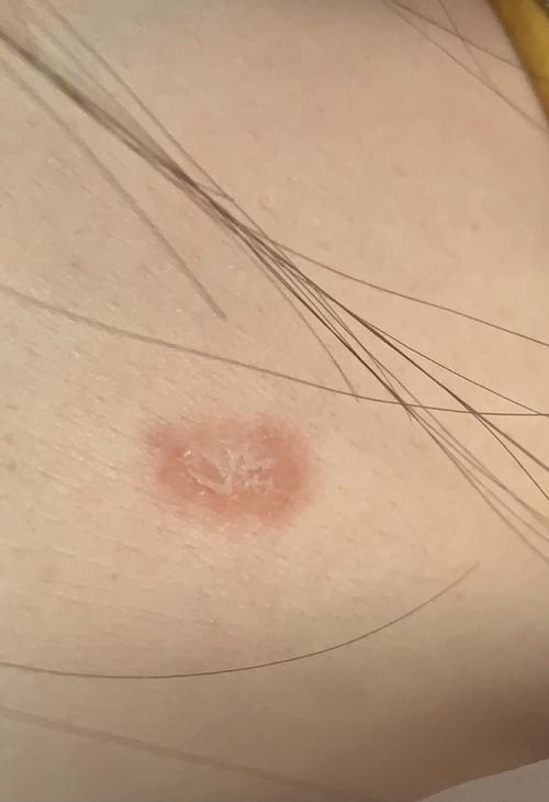 人被传染全身长猫癣怎么办有图