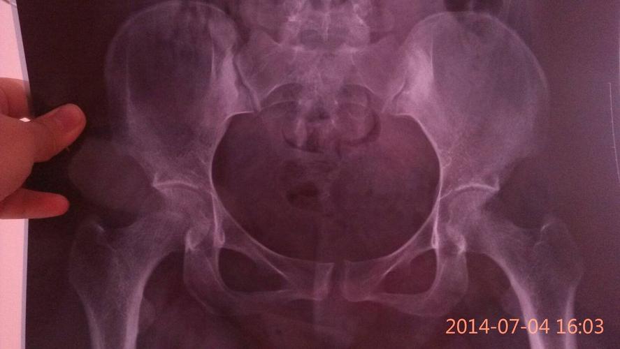 问:产后耻骨联合分离,左侧躺时左坐骨疼是什么原因?