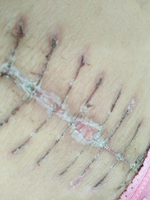 抛妇产18天,竖切口,偶尔肚子有点疼,这样是没恢复好吗