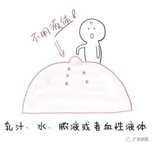 乳头溢液最常见的症状是乳头有乳汁流出,很多女性朋友以为是正常