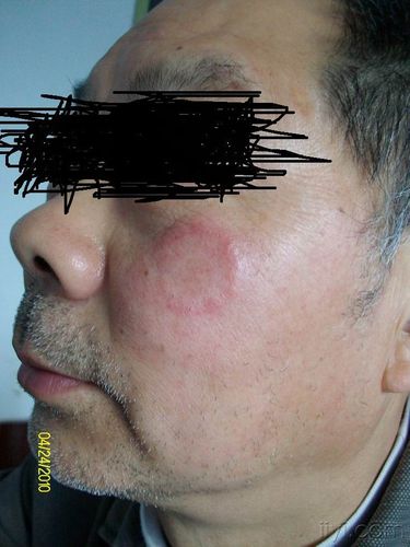 面部皮损2周癣结果已修正