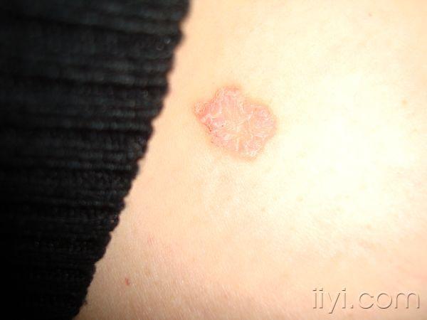 看图说话——钱币状湿疹?