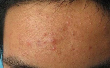 长春皮肤病研究所专家介绍:内分泌失调引起痤疮的原因