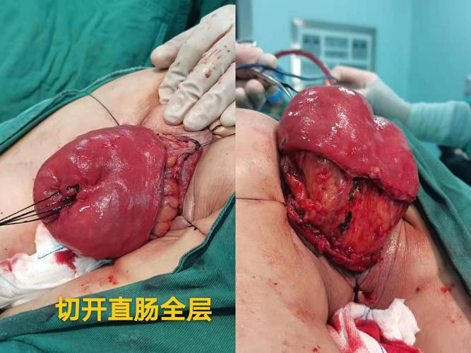 [手术案例]altemeier手术治疗直肠脱垂—附属南华医院