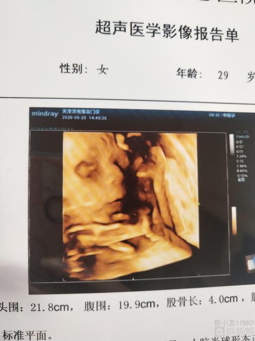 四维彩超出来了[比心]欢迎大家猜男女!胎