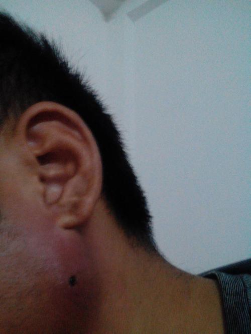 大脑上长了个疖子,后来又变成痈了,像我这个不看的话能自愈吗!