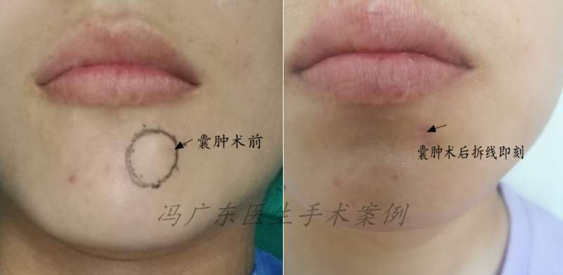 皮肤外科门诊之表皮囊肿