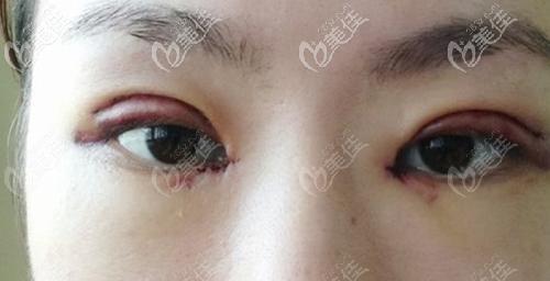 做完双眼皮后眼皮发黑早期可能你是淤血黑化,中期可能是色素沉着或者