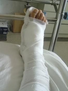 有没有腿部打了石膏的朋友能拍张腿部石膏照片啊?