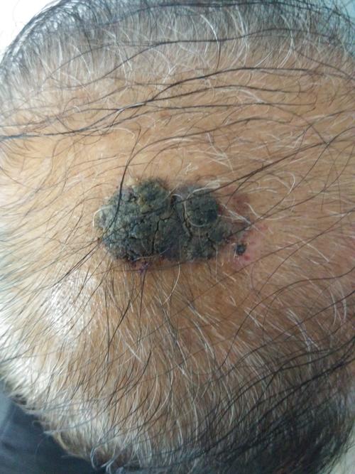 脂溢性角化病会不会恶变?