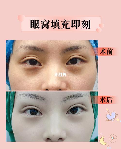 95上眼窝凹陷,让人看起来非常显老,自体脂肪填充眼窝即刻99瞬间