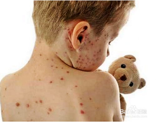 育儿 > 幼儿期   1 发现患有水痘时让他不要跟小朋友玩,以免被传染