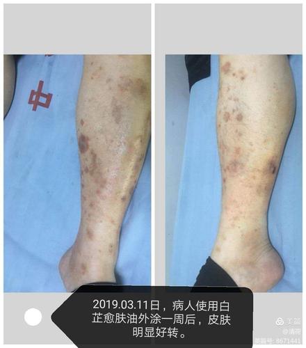 一例糖尿病皮肤病变病例观察