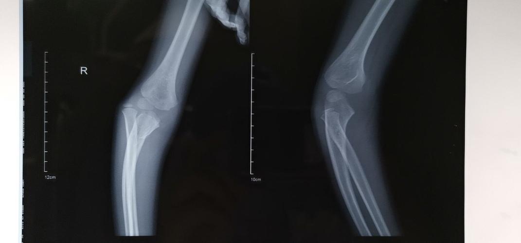 尺骨鹰嘴骨折伴桡骨小头脱位