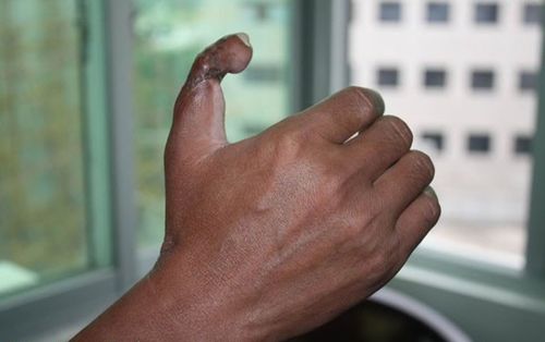 聚焦农民工:手掌接脚趾,医院良心何在?