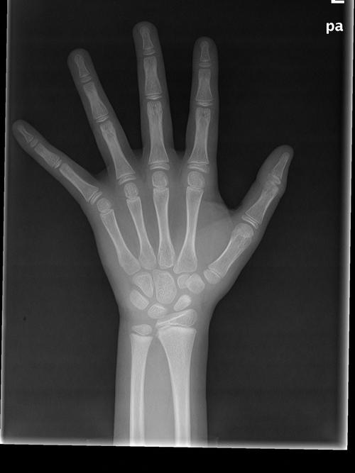 如果骨龄检测片子上出现籽骨 说明发育了_运动_儿童身高发育_母婴