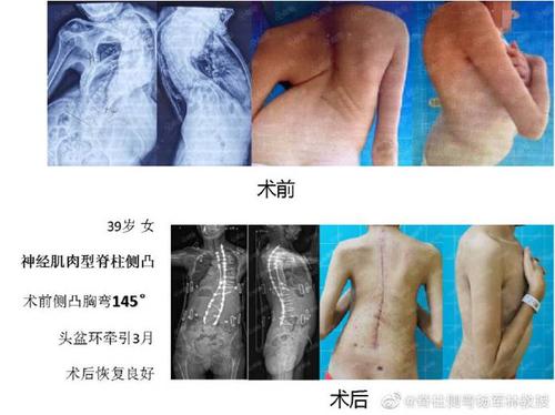 重度脊柱侧弯矫正手术实例二