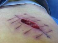 化脓性阑尾炎术后感染是什么引起的