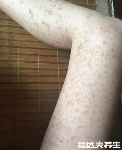 玫瑰糠疹怎么引起的会传染吗,不会传染但病因不详(图片)