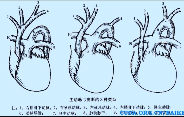 主动脉弓离断病例分享