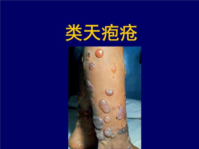 类天疱疮知识课件.ppt 20页