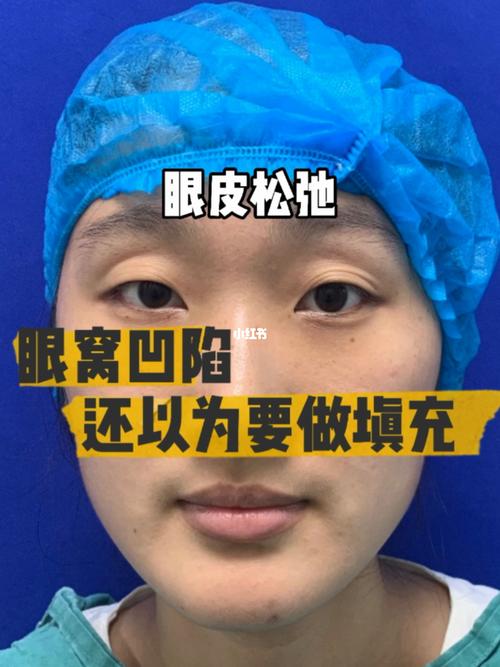 本来以为要给眼窝凹陷填充,万万没想到_双眼皮手术_上海自由行热门