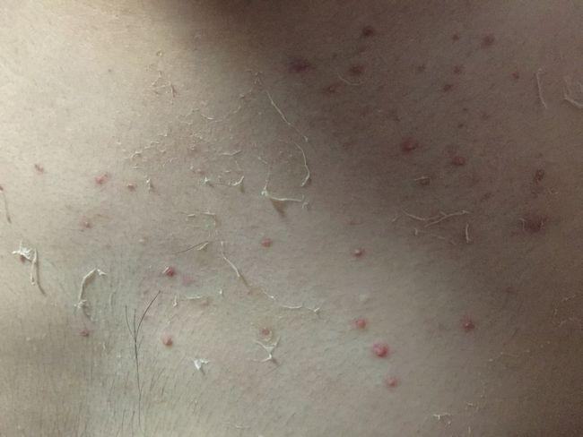 不要把艾滋病误认为普通的皮肤病皮肤异常有五种可能是hiv