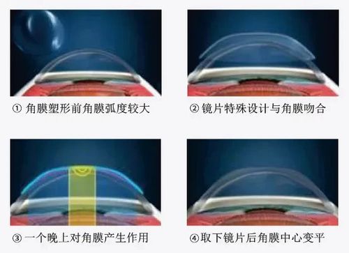 角膜塑形镜矫正原理# 角膜塑形镜一旦验配,需要家长和孩子的共同