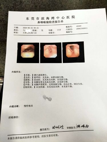 为一例喉部白斑患者进行了经支撑显微喉镜二氧化碳激光声带白斑切除术