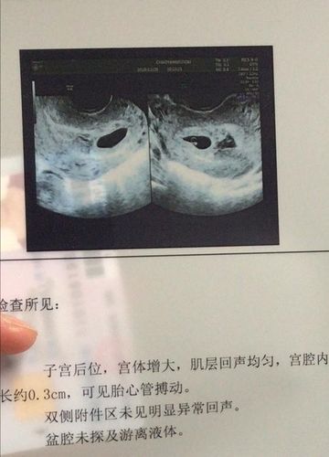 45天男孩胎囊图片