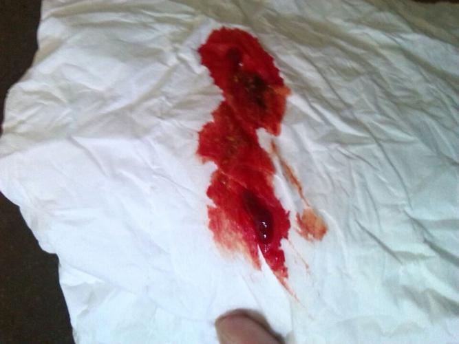 主治医师来自随州市中医院 答: 你好,痔疮是会引起大便带血的,建议你