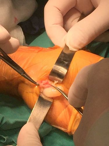 手部常见肿块以腱鞘囊肿为例的诊断和处理