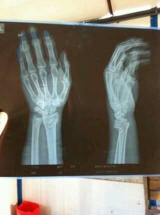 患者59岁,左桡骨远端骨折,骨折断端明显