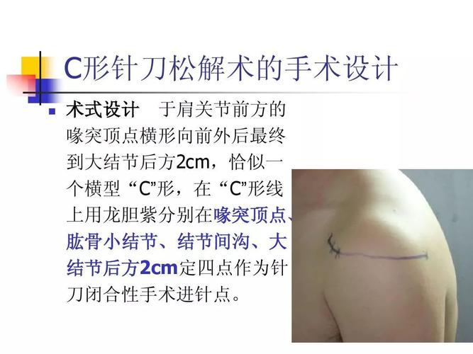 肩关节"c"形针刀松解术治疗肩周炎