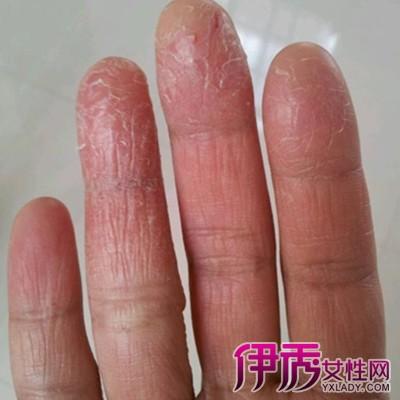 【图】手指头脱皮开裂怎么办? 6个小偏方帮你快速解决