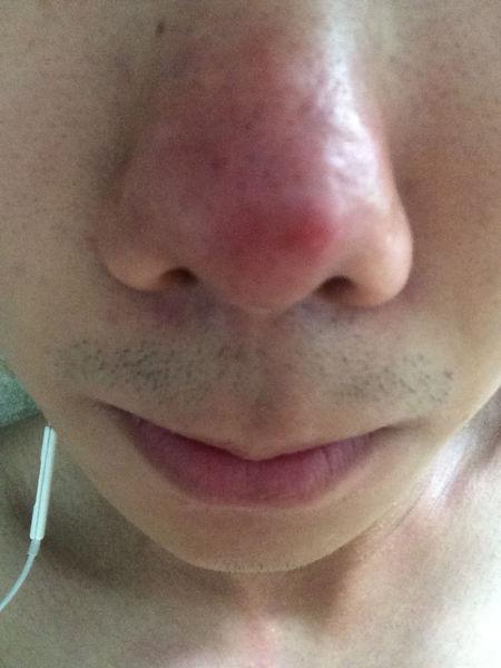 鼻头长了个痤疮 但是手贱用力挤发炎了 更厉害了 周围