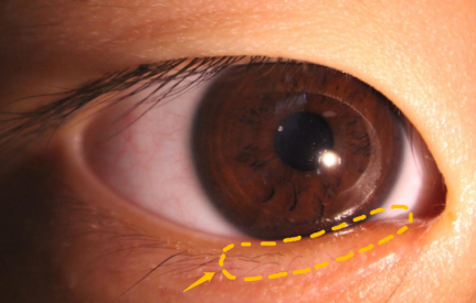 5岁男童眼睫毛"倒着长"!这种先天眼病常被家长忽视