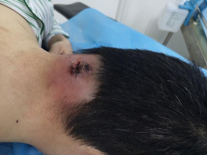 20床颈后部疖肿