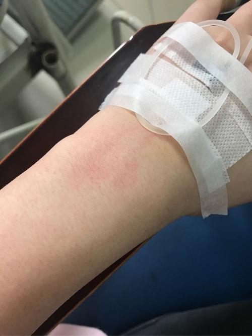 为什么静脉注射阿奇霉素对血管刺激这么严重?