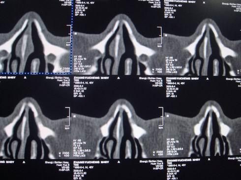 ct21424:鼻骨骨折