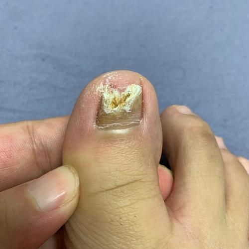 断药了12天  一共是20天吧 第三张相片新指甲已经长出来了